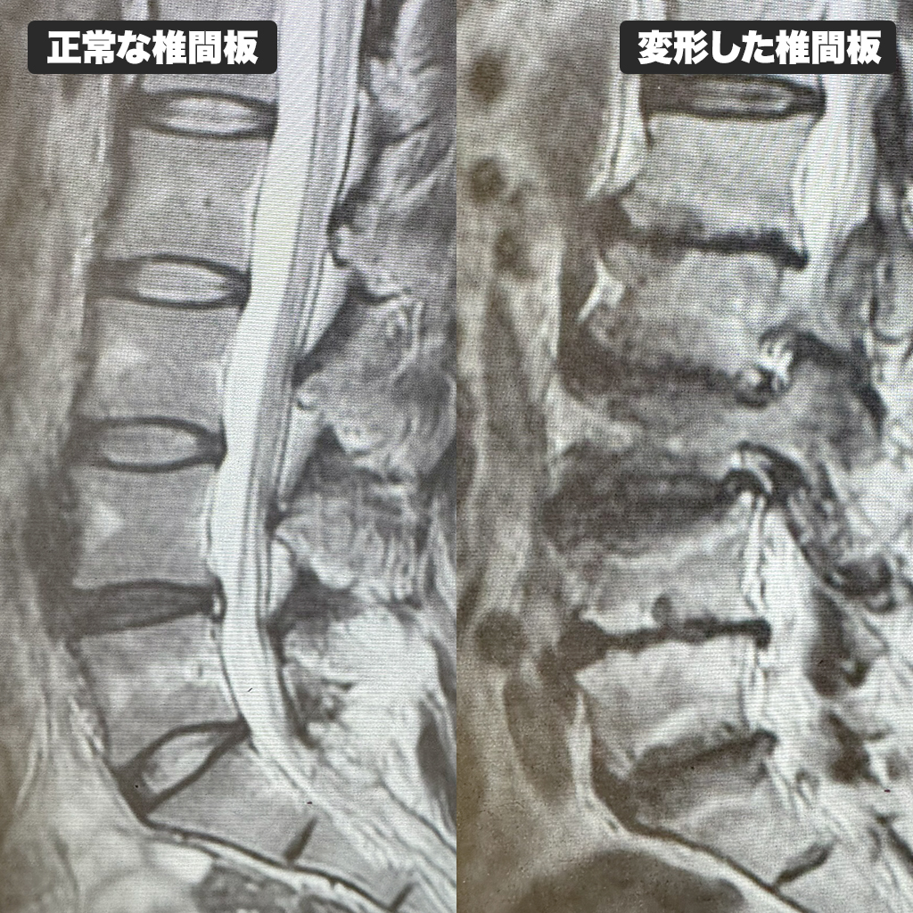 治療前のMRI検査