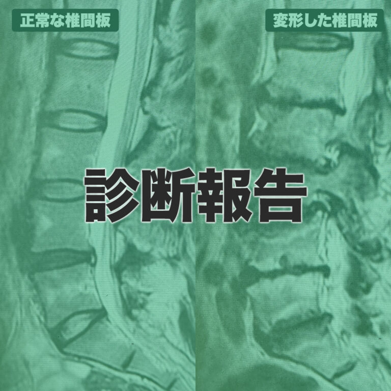 限界を超えた腰（60代男性）