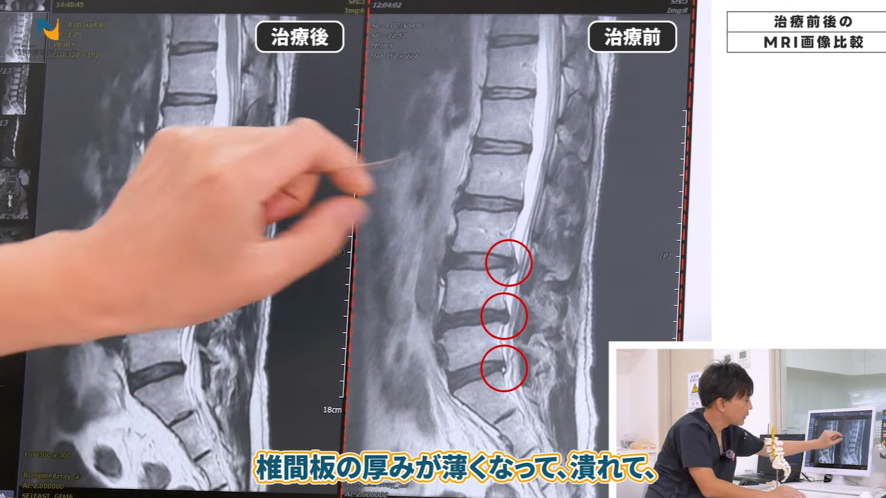 椎間板潰れている