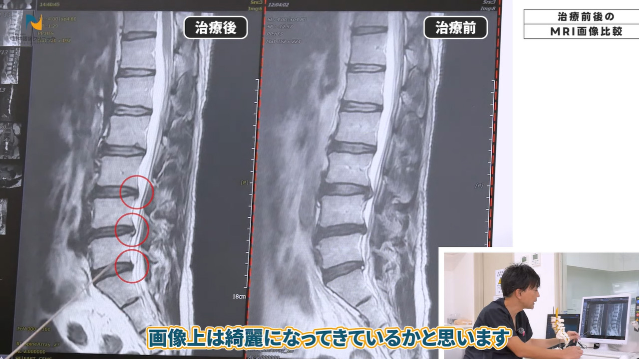 椎間板きれいになっている