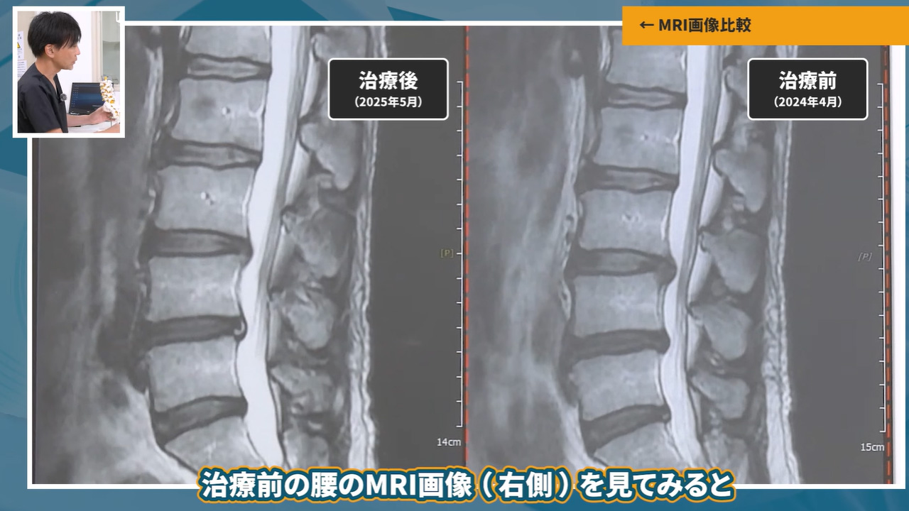 治療前・後のMRIの状態