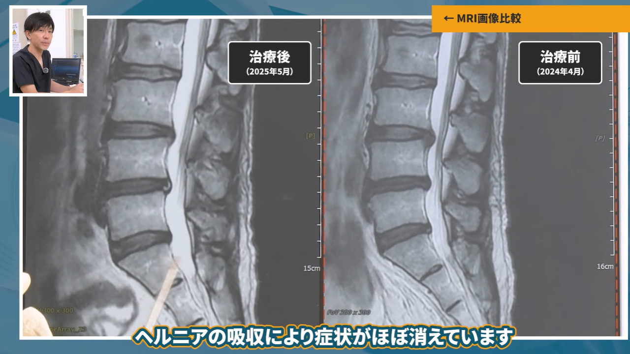 坐骨神経痛は消失