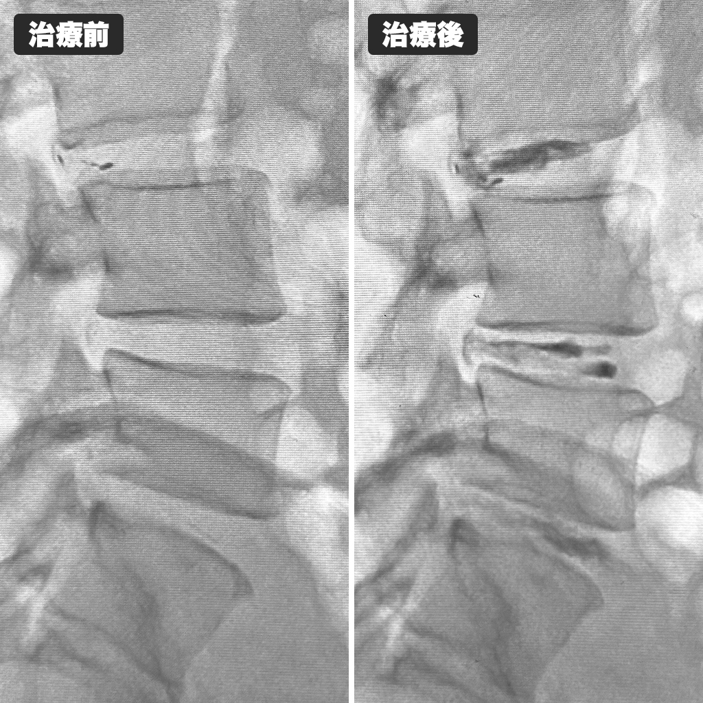 治療前後のレントゲン
