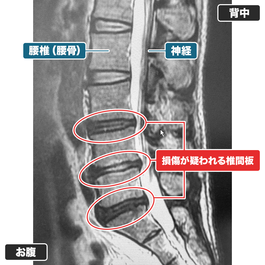 MRI