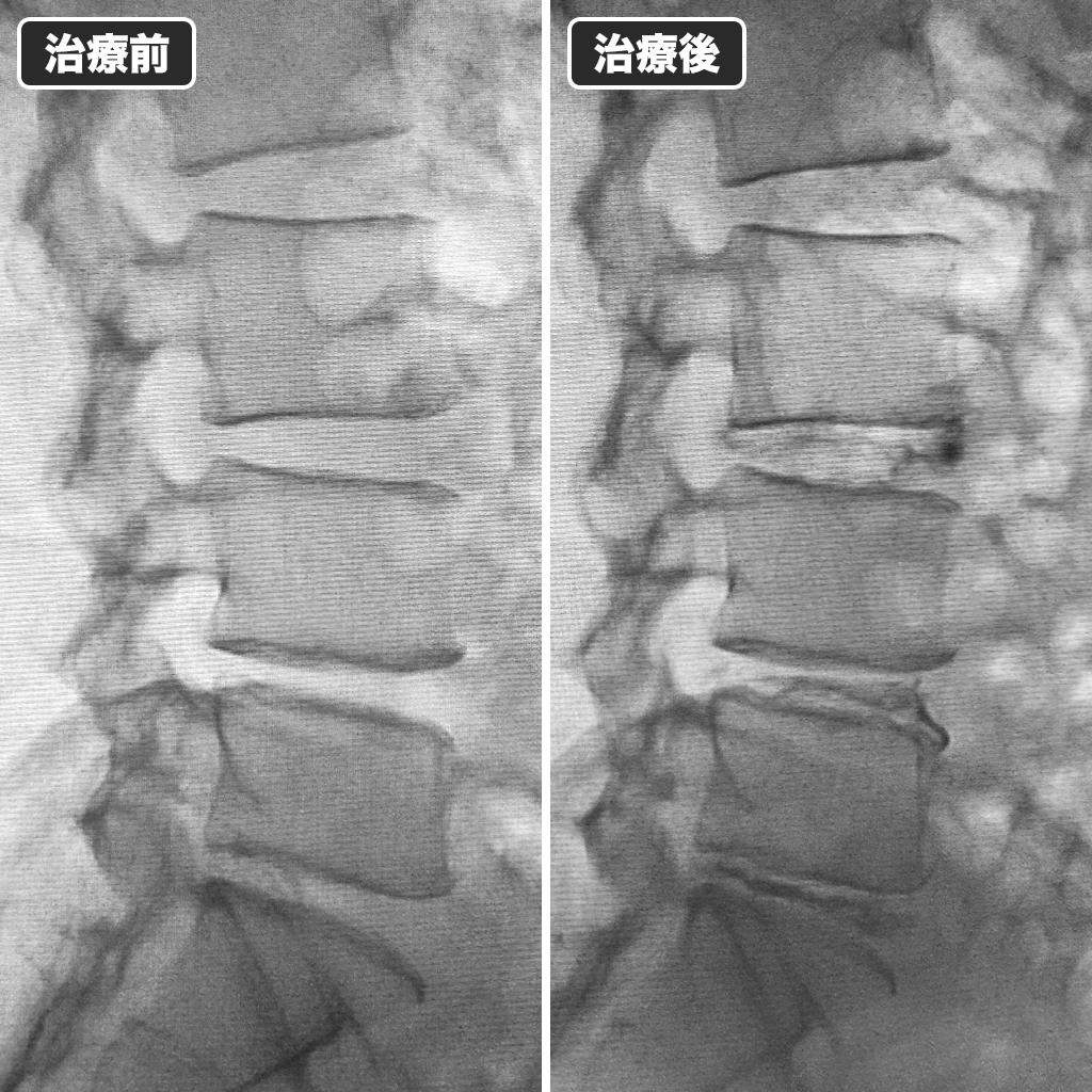 治療前後のレントゲン