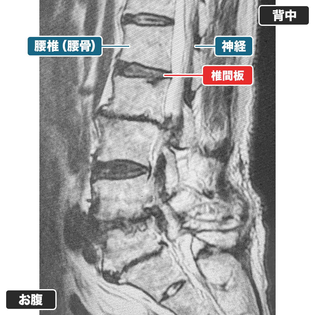 改善した患者さまのMRI