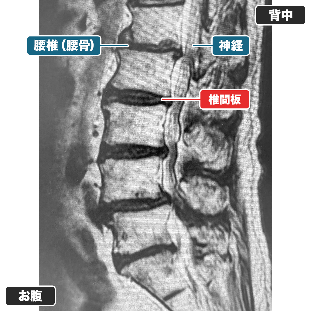 改善しなかった患者さまのMRI