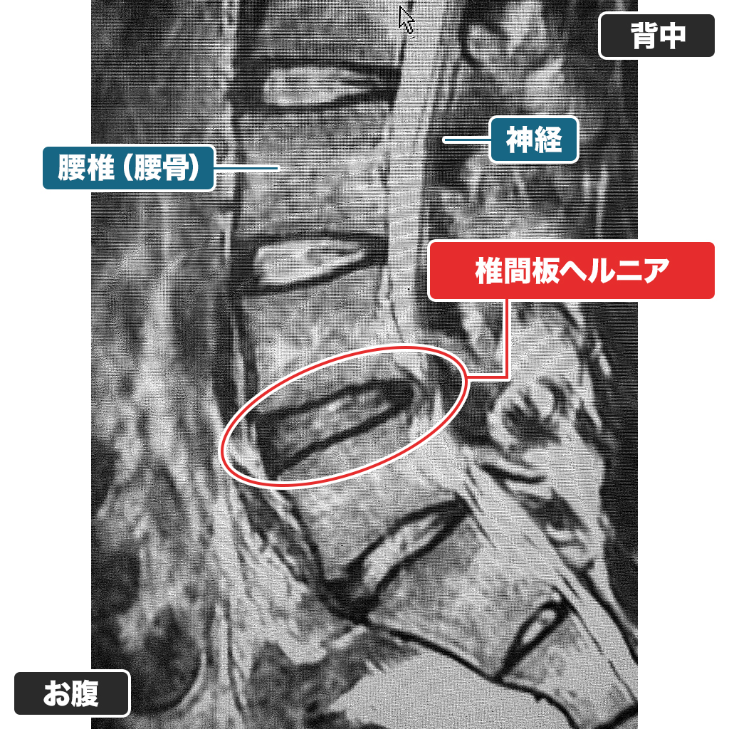 MRI