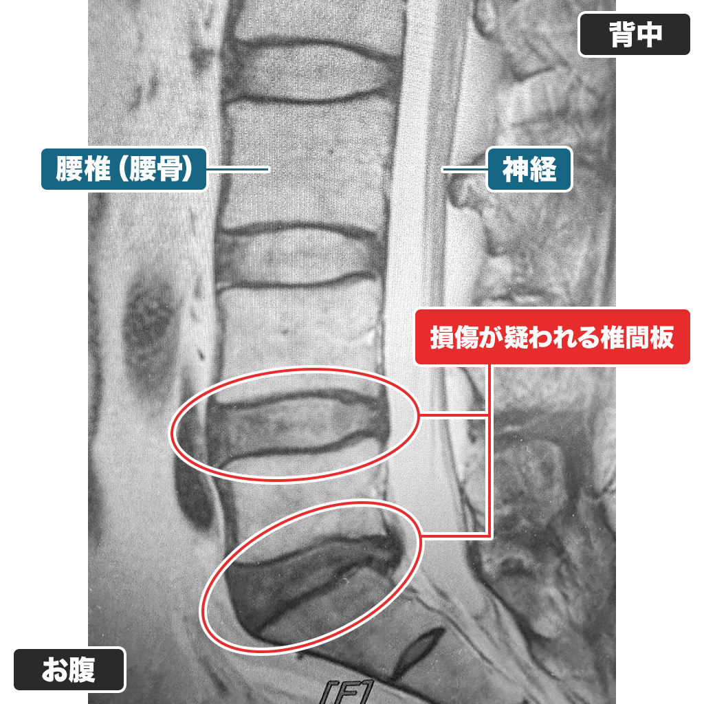 MRI