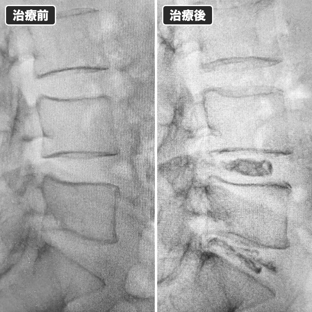 治療前後のレントゲン