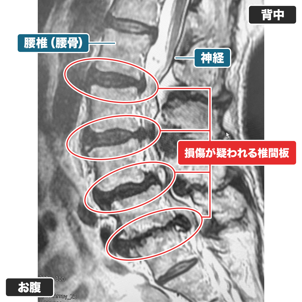 MRI
