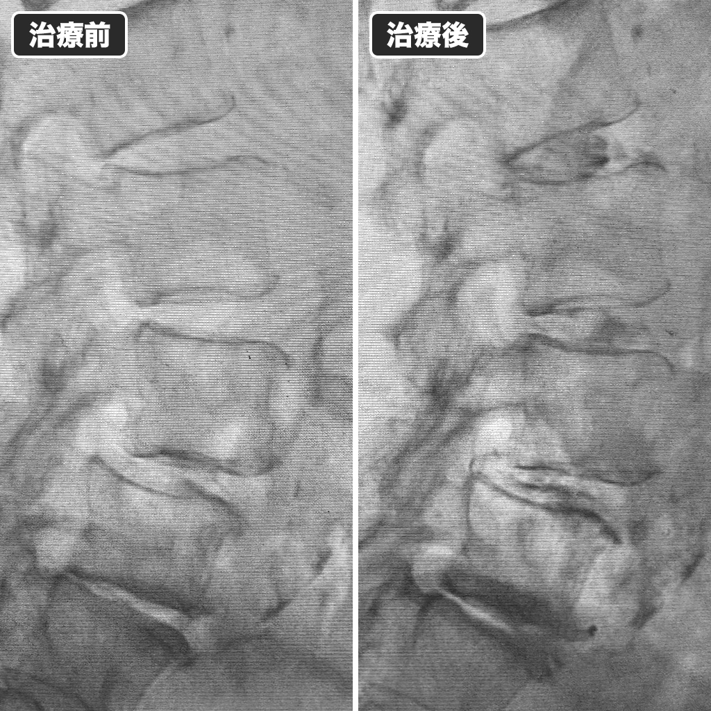 治療前後のレントゲン