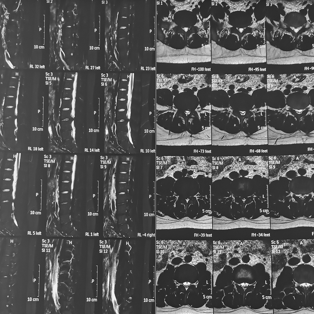 MRI
