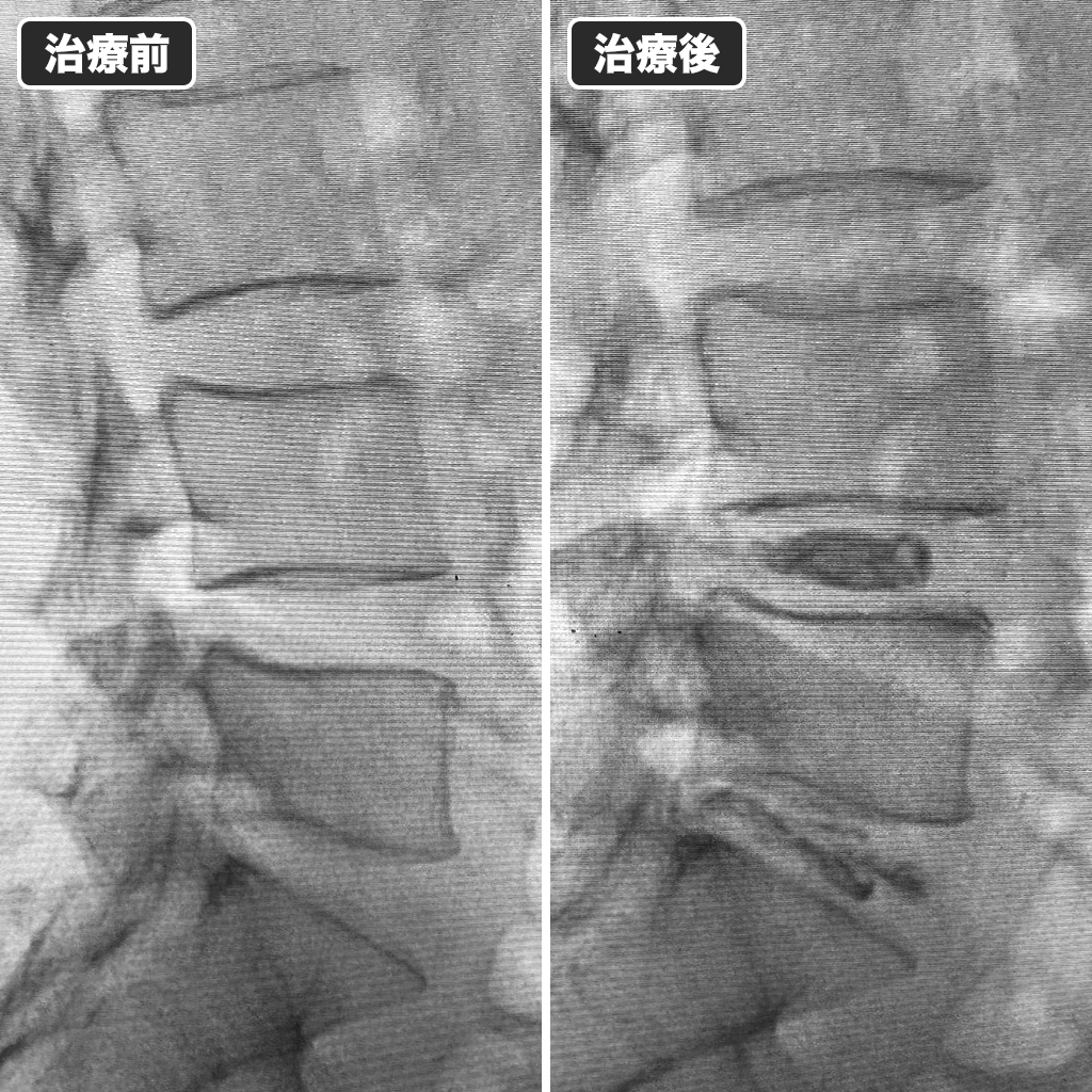 MRI