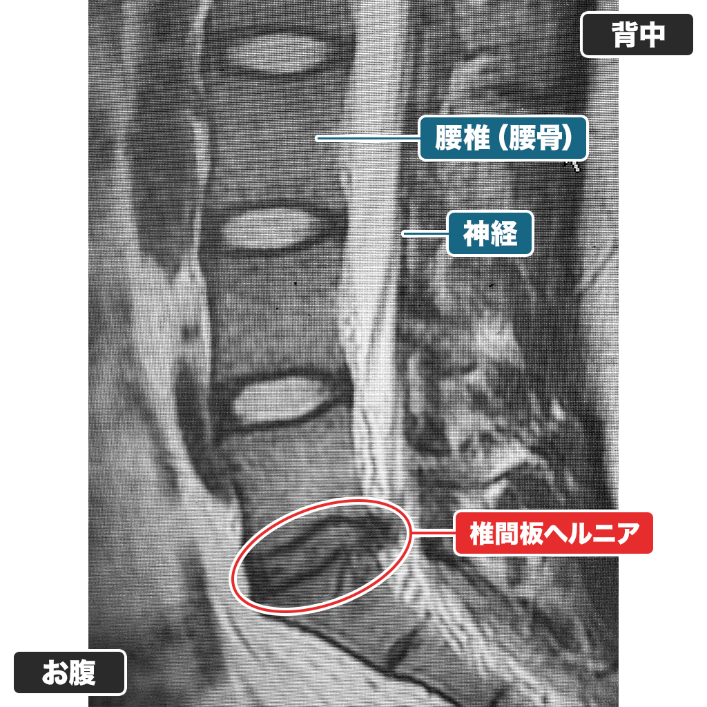 治療前のMRI検査