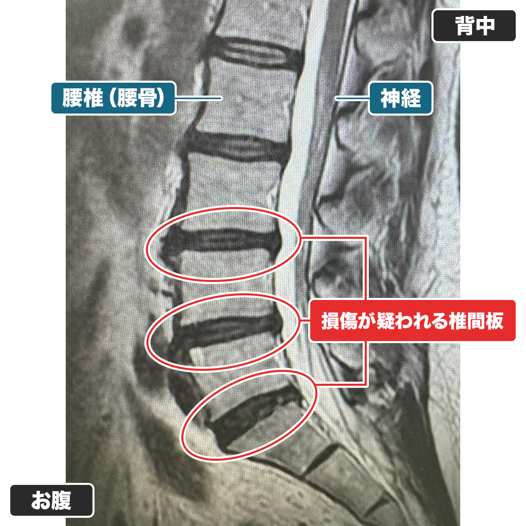 MRI