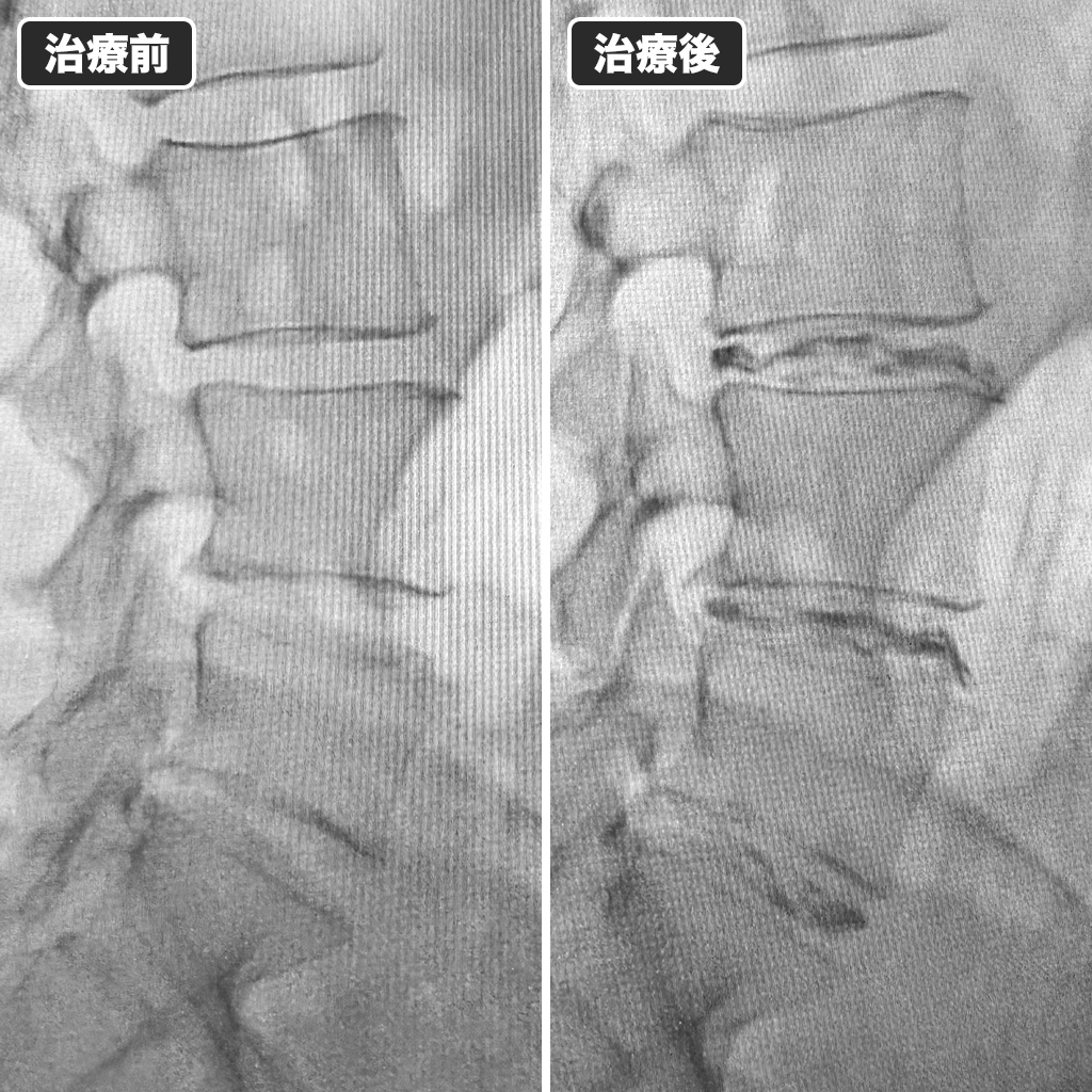 治療前後のレントゲン