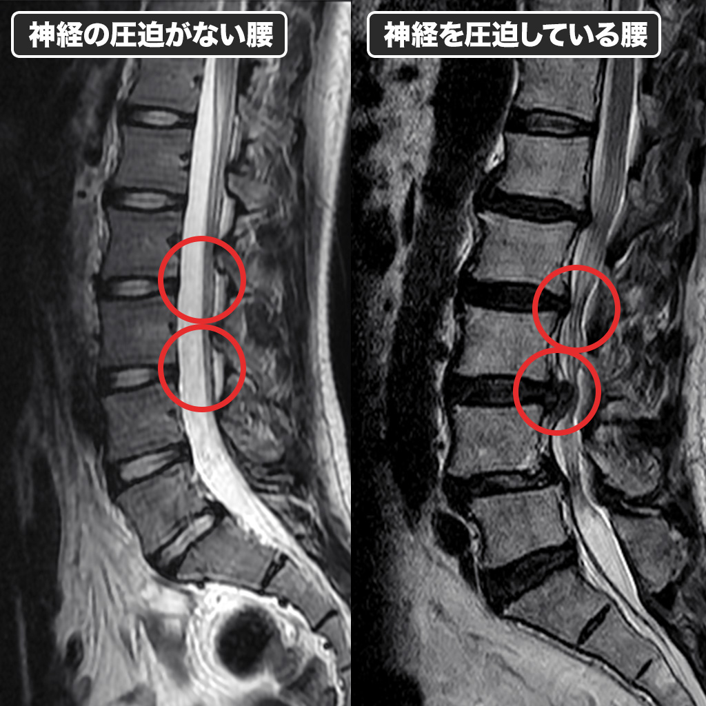 神経圧迫の様子を比較した画像