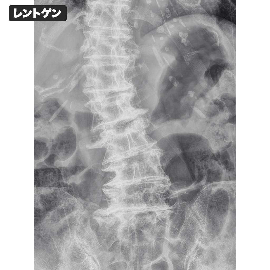 変形性側弯症のレントゲン画像