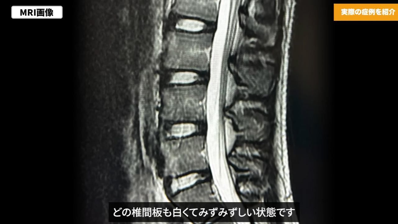 MRI画像