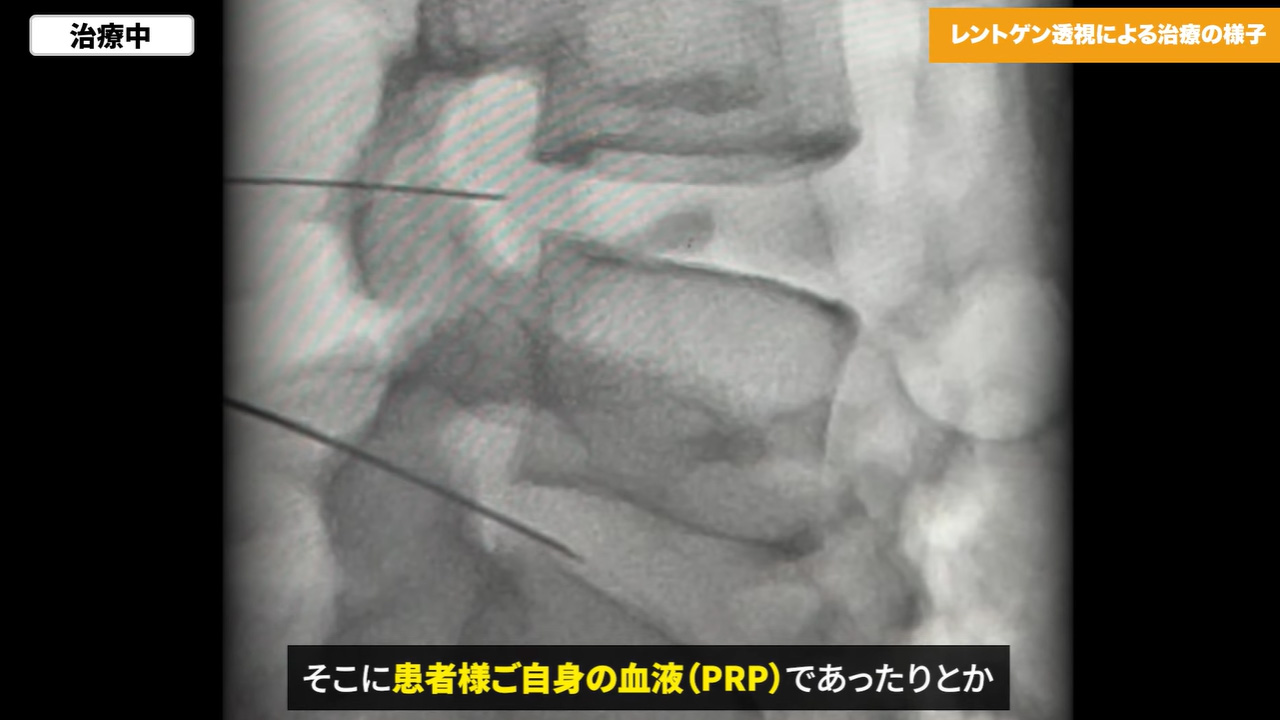 治療の画像