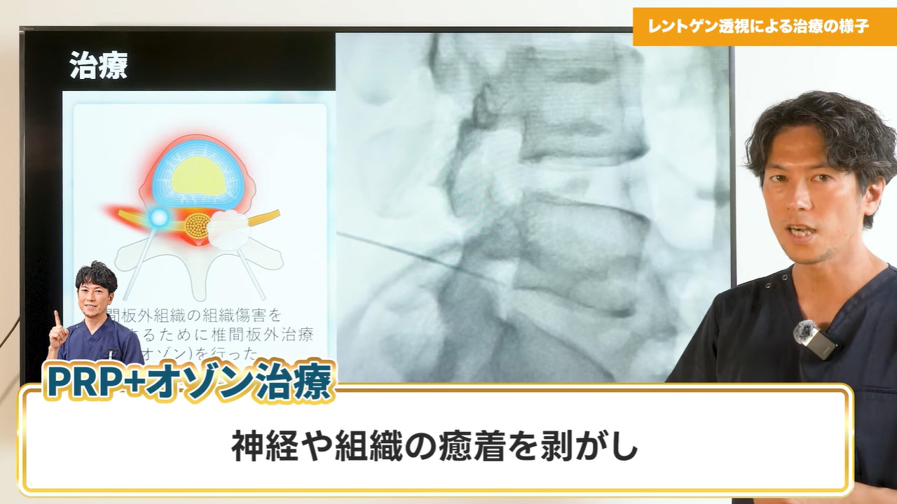PRP療法+PODT法①