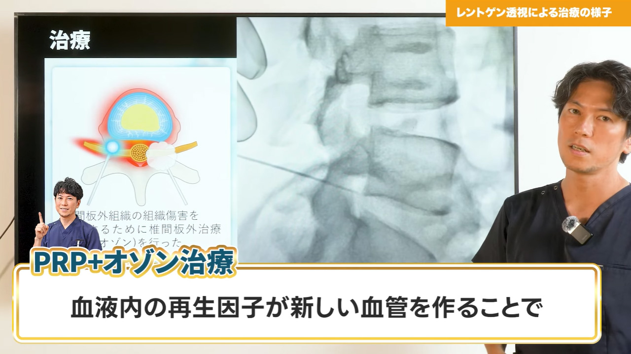 PRP療法+PODT法②