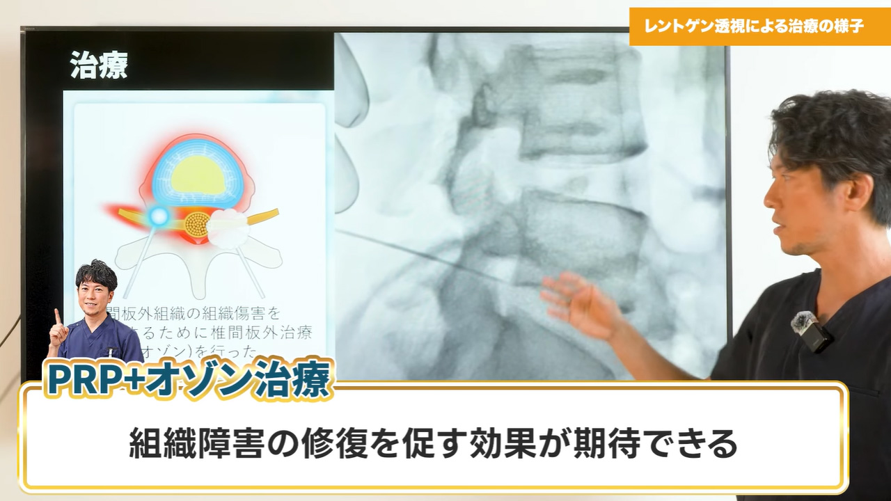 PRP療法+PODT法③