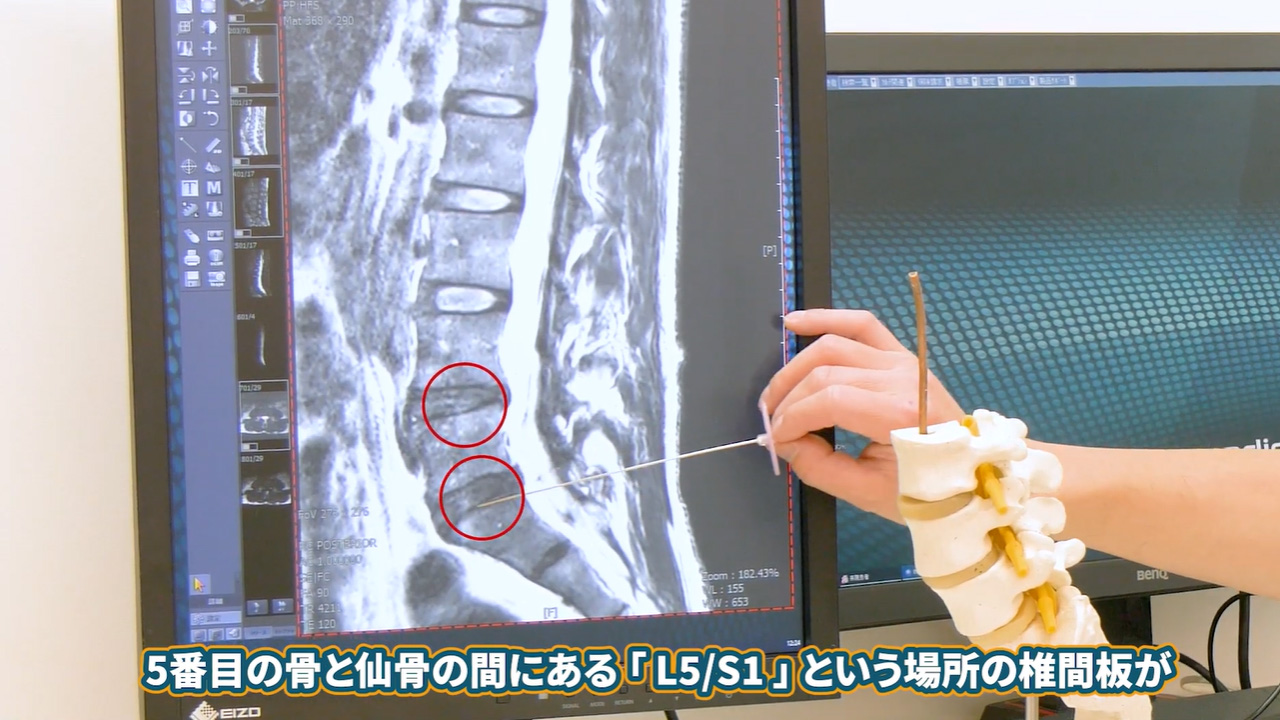 椎間板損傷の場所