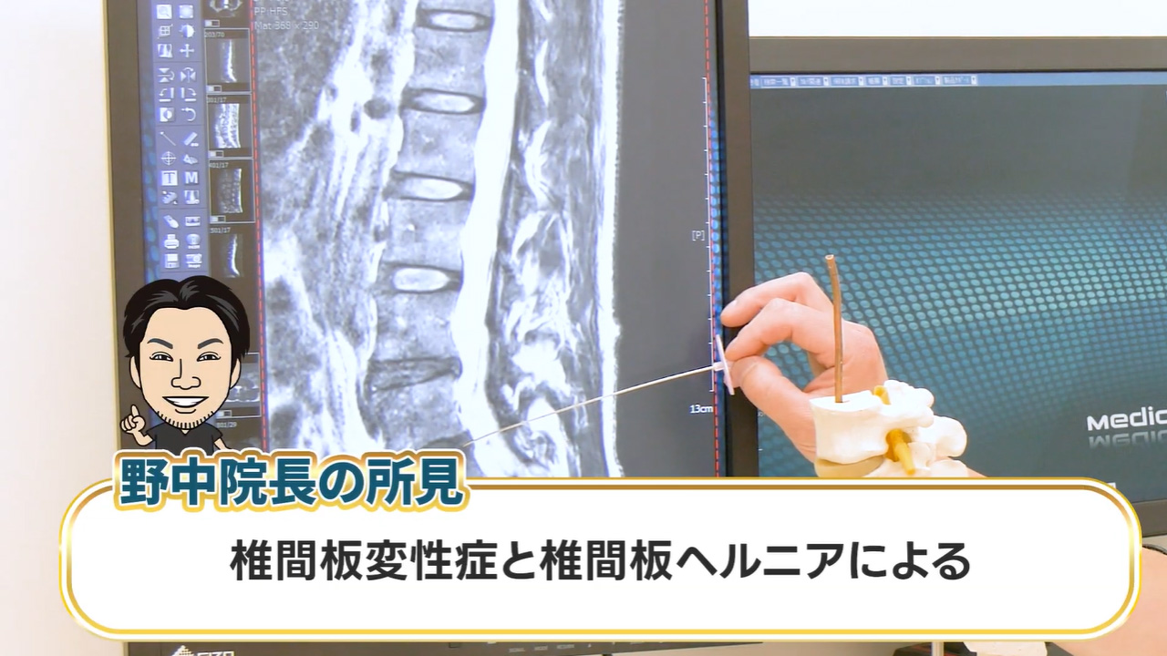 院長の所見:椎間板変性とヘルニア