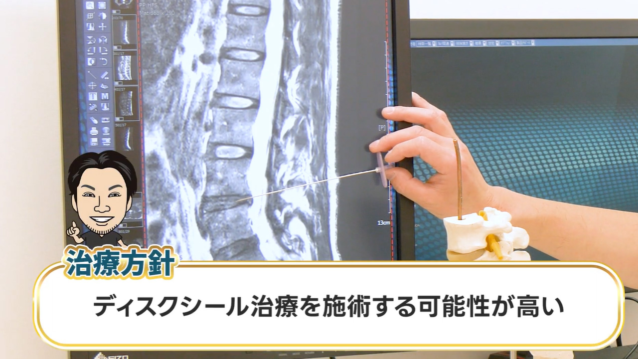 院長の所見:ディスクシール治療の可能性