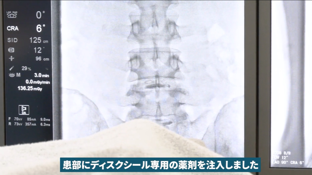 ディスクシール専用の薬剤注入