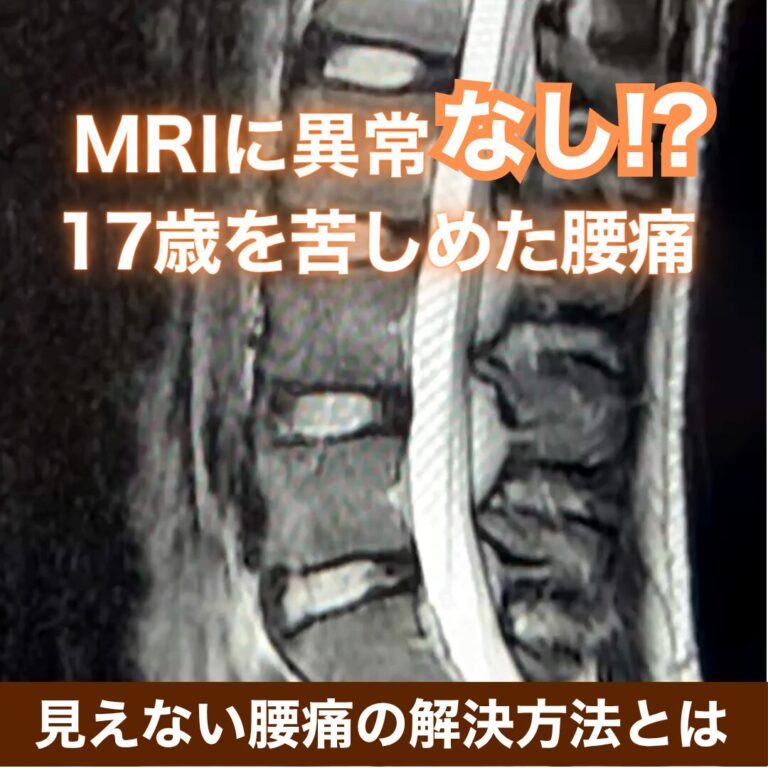 【改善実例】MRIに異常なし⁉️17歳を苦しめた「見えない腰痛」