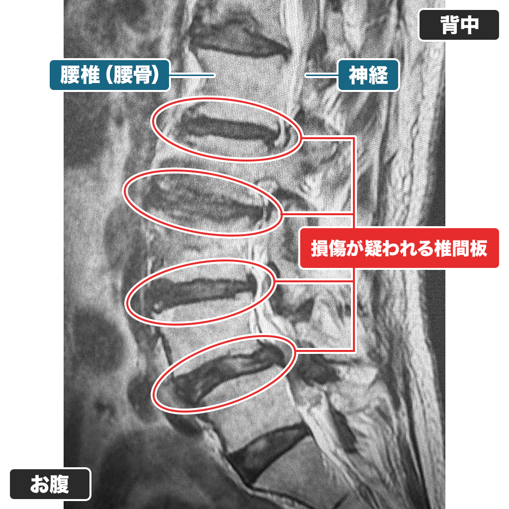 MRI