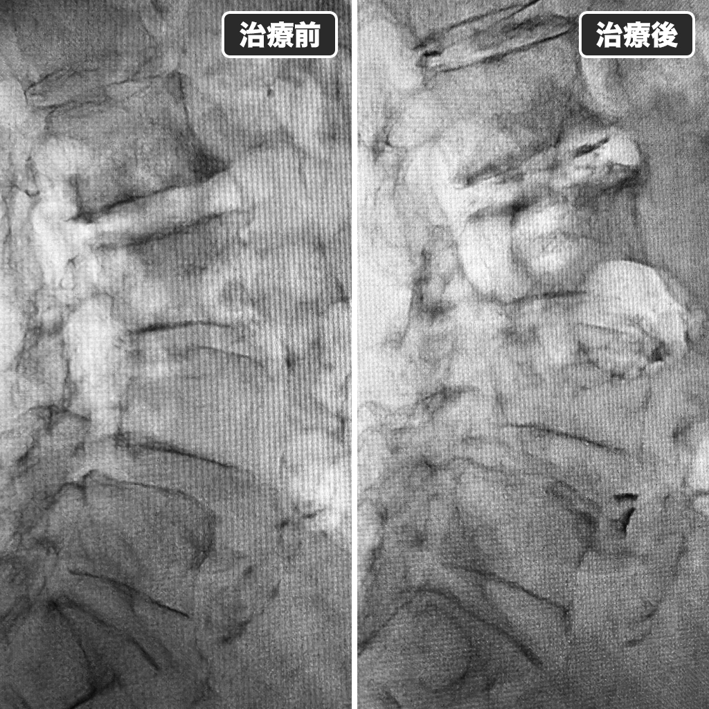 治療前後のレントゲン