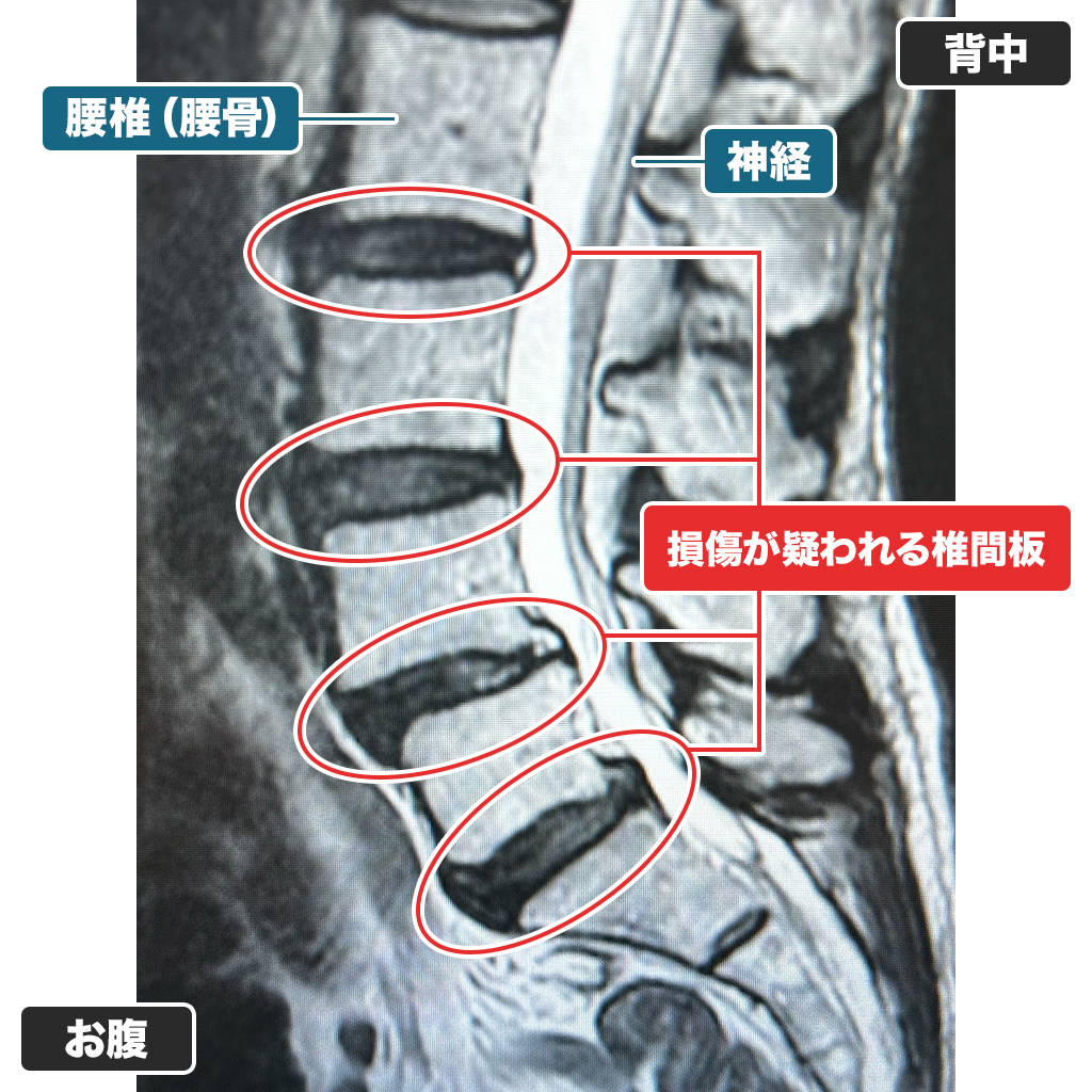MRI