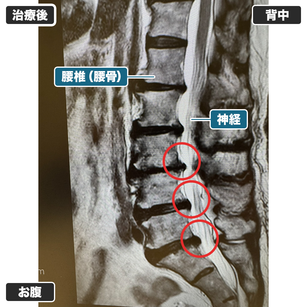 治療後6ヵ月経過したMRI検査