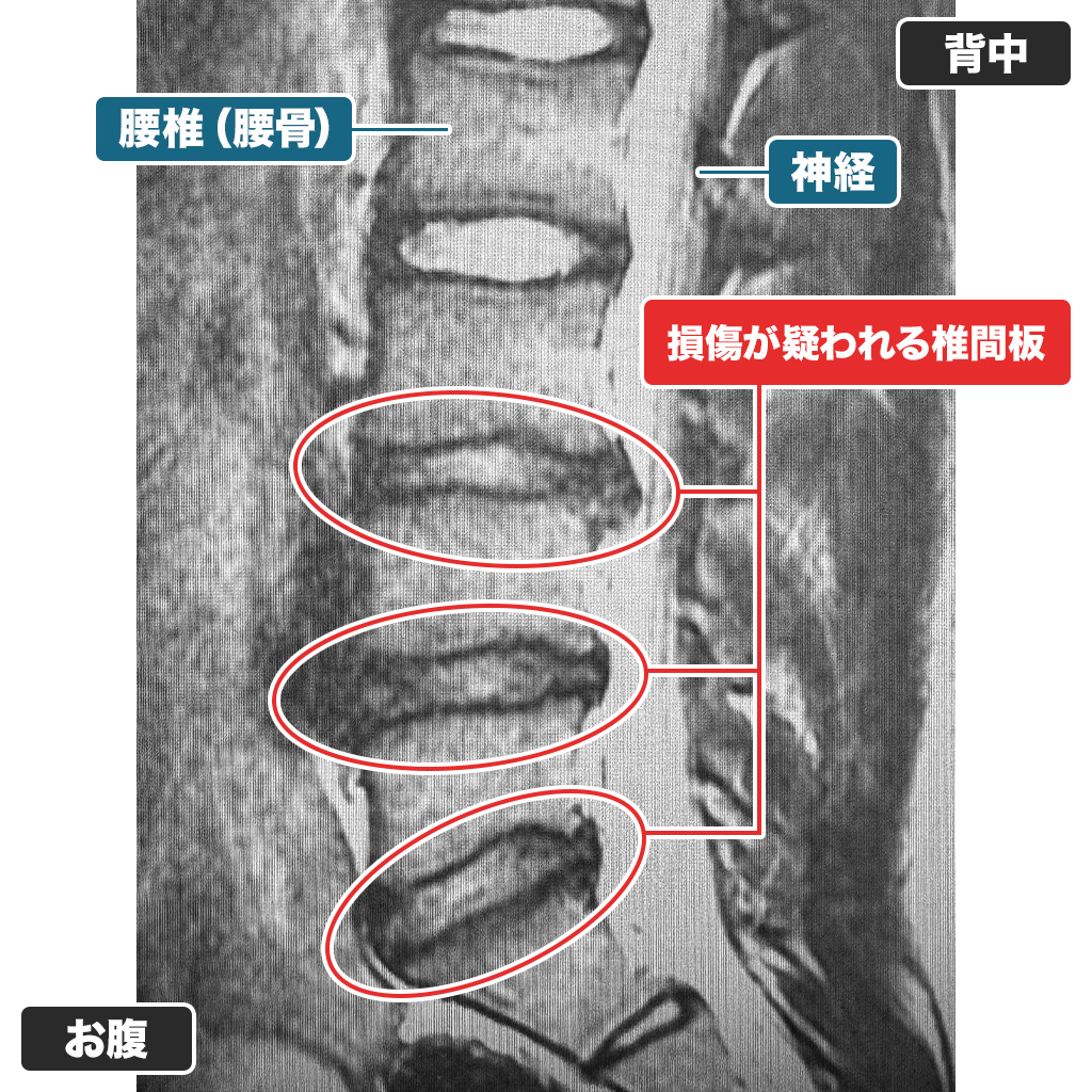 MRI