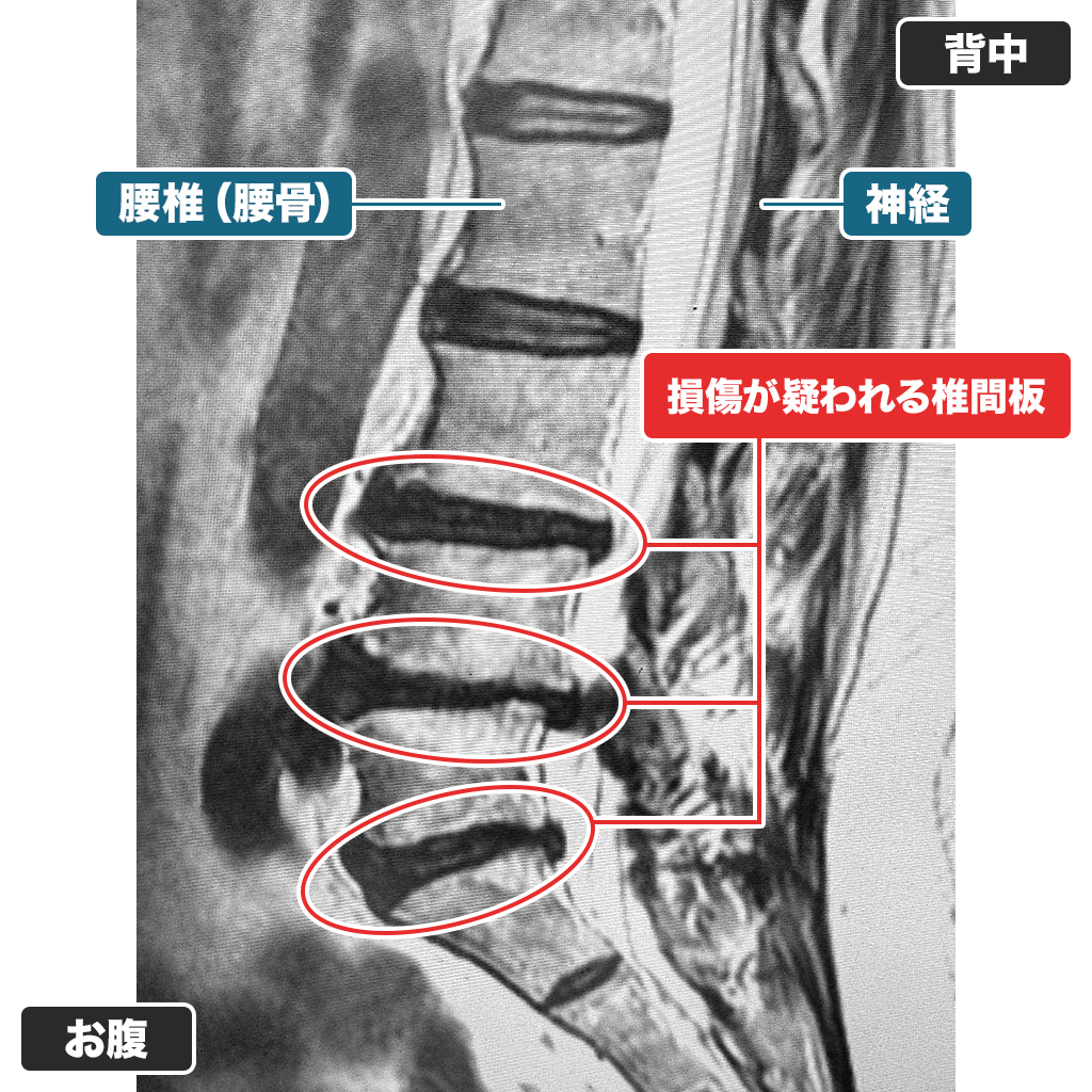 MRI