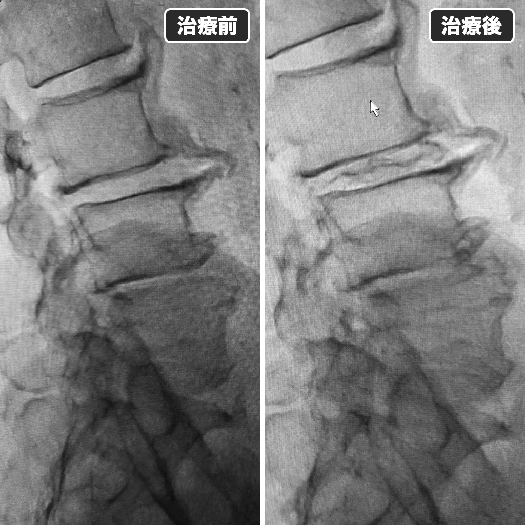 治療前後のレントゲン