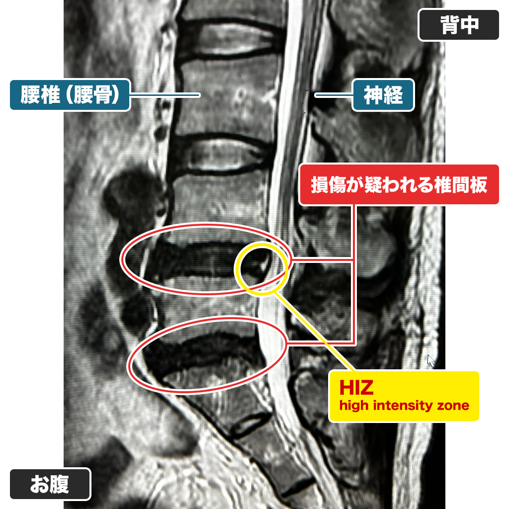 MRI