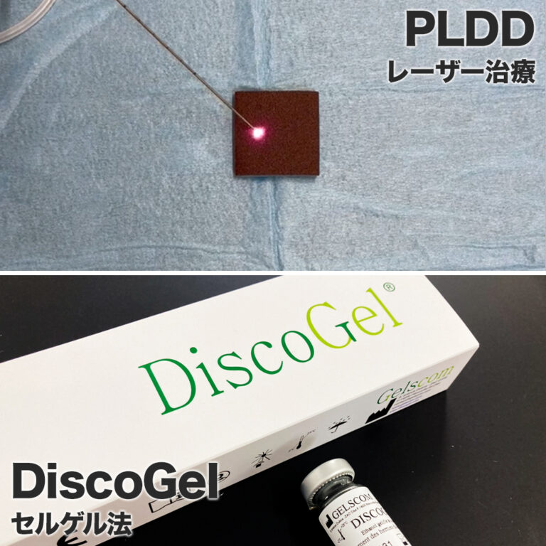 【するどい質問】PLDDとディスコゲル治療（セルゲル法）の違い