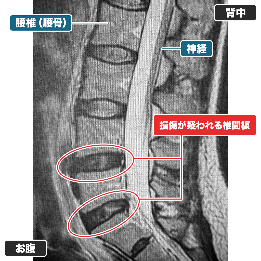 MRI