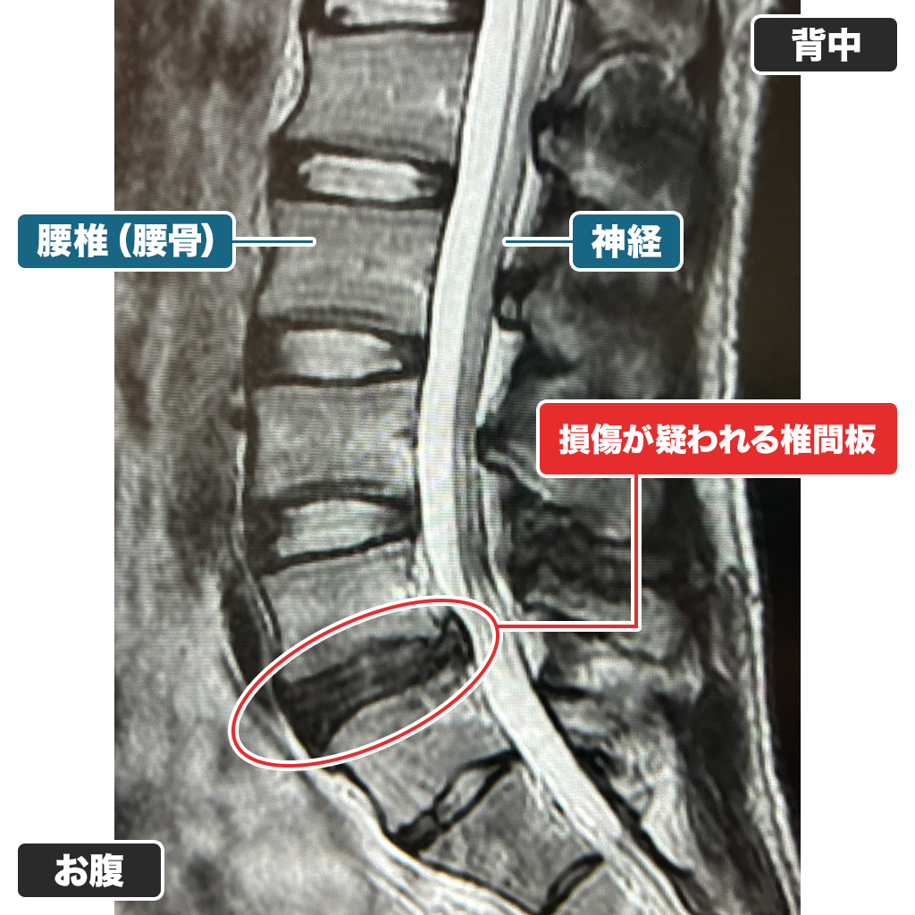 MRI