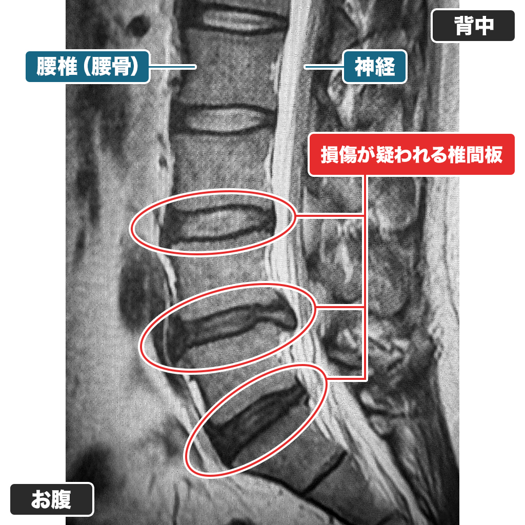MRI
