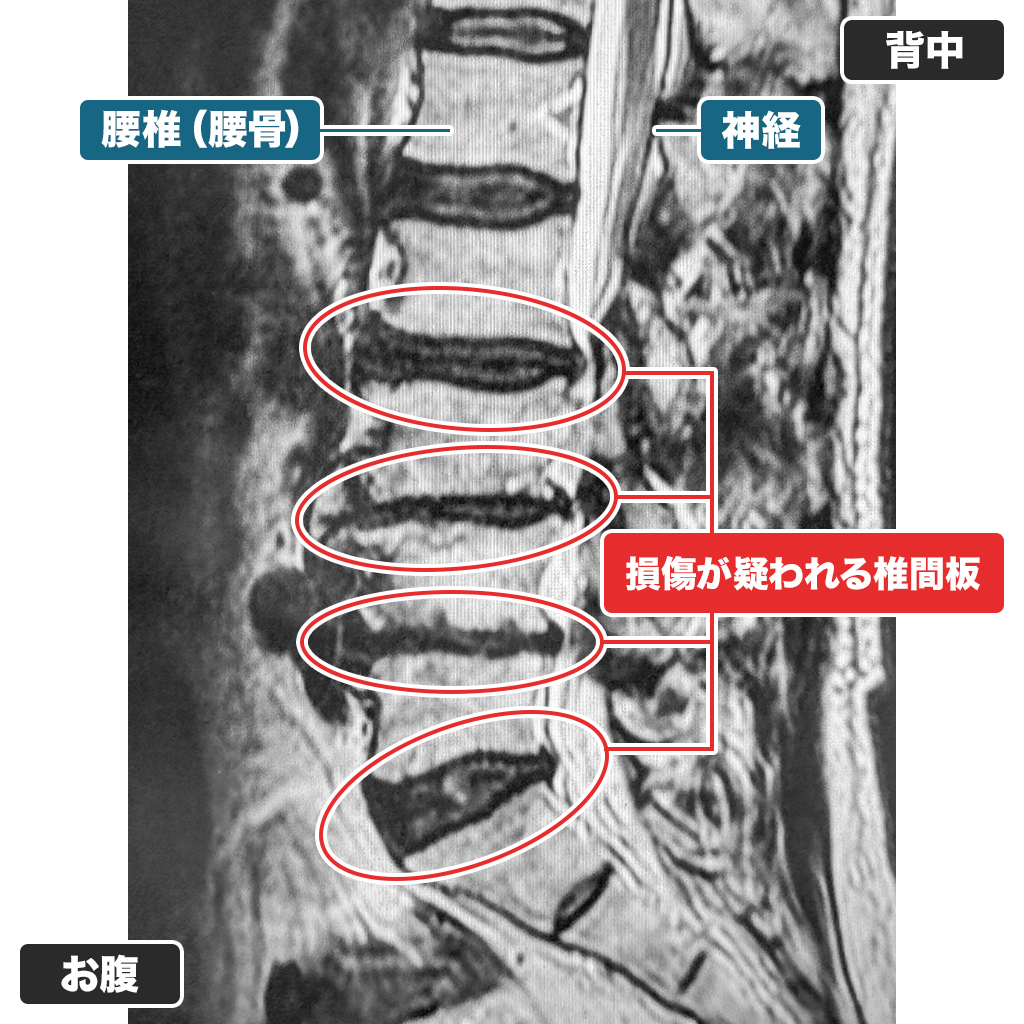MRI