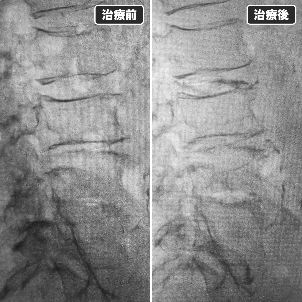 治療前後のレントゲン