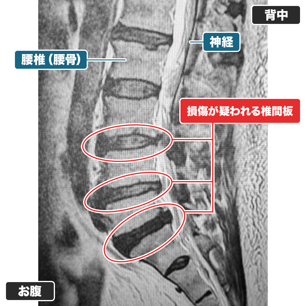 MRI