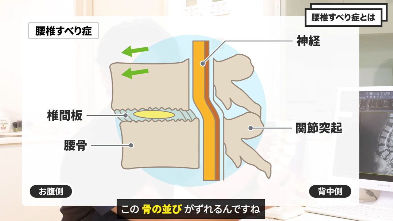 前方に滑ったすべり症イラスト