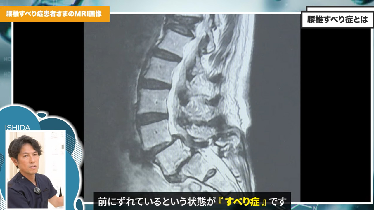 すべり症の患者MRI画像